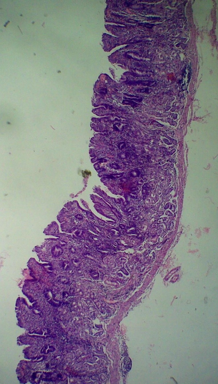 Atrophic gastritis