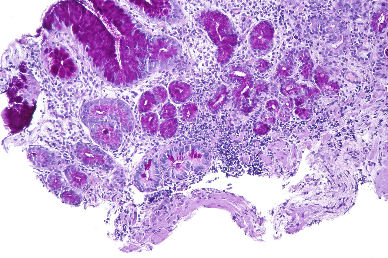 Atrophic gastritis