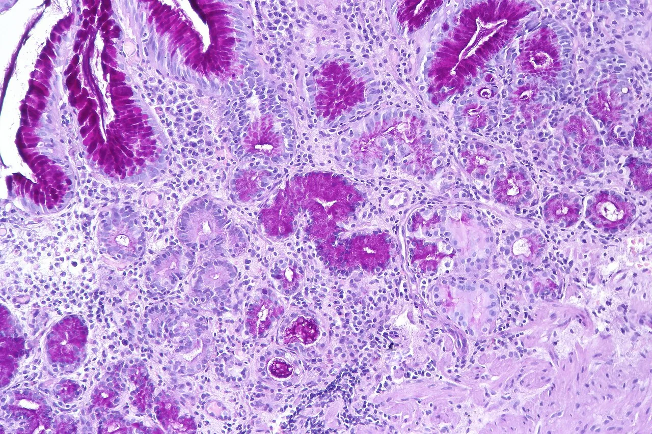 Atrophic gastritis