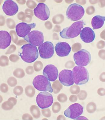 Chronic lymphocytic leukemia