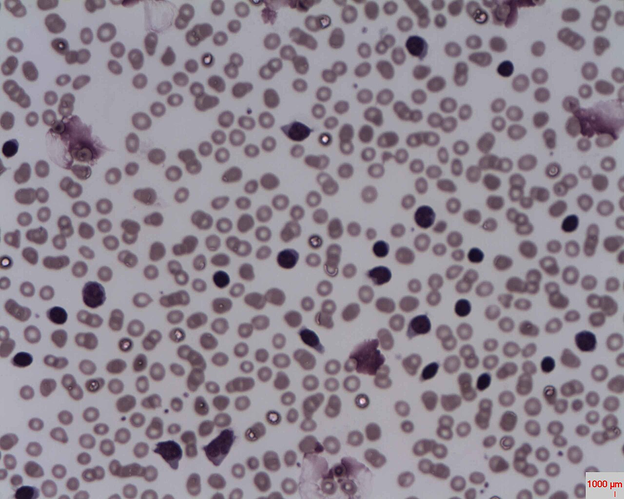 Chronic lymphocytic leukemia