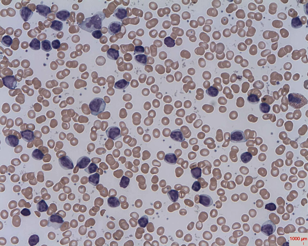 Chronic lymphocytic leukemia