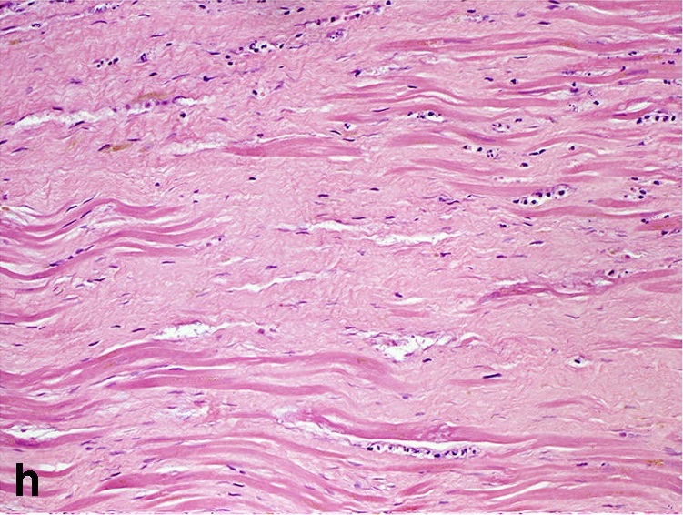 Collagen loss