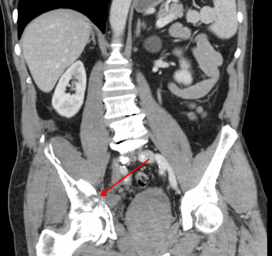Acetabular fracture