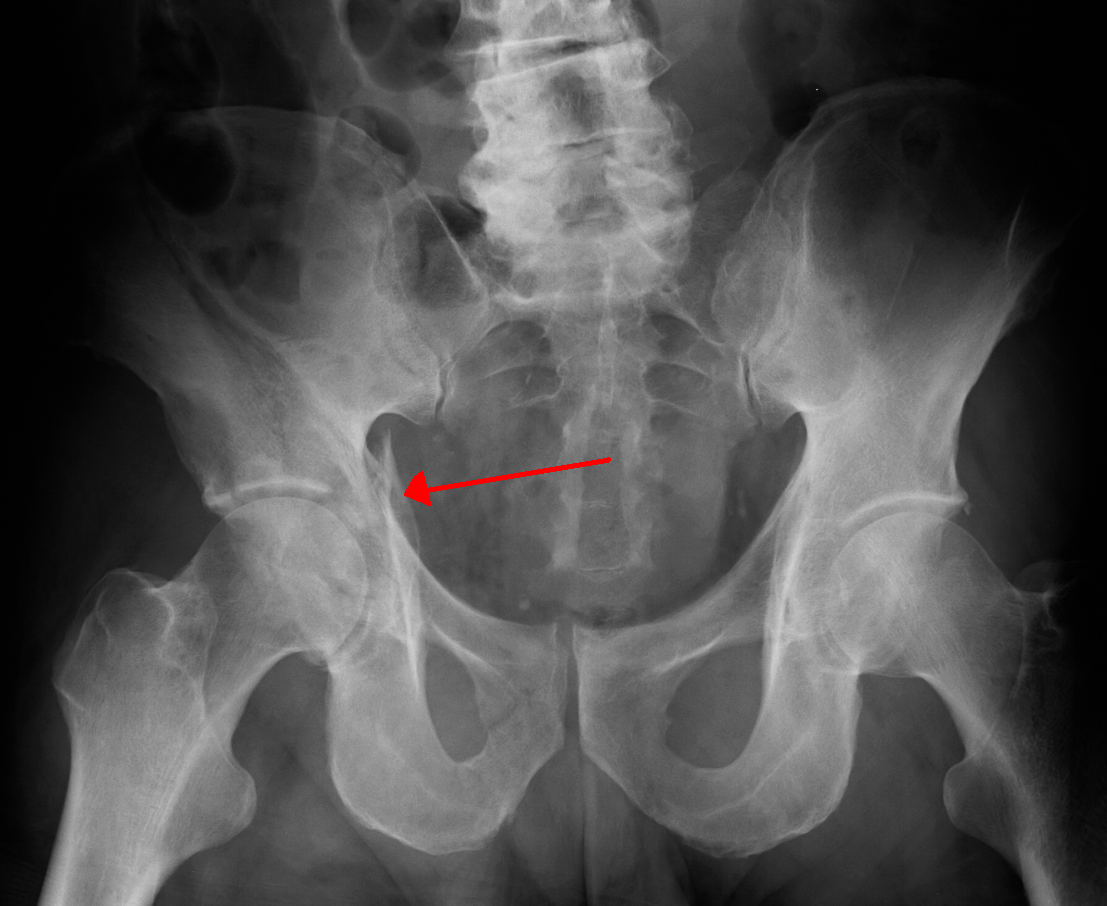 Acetabular fracture