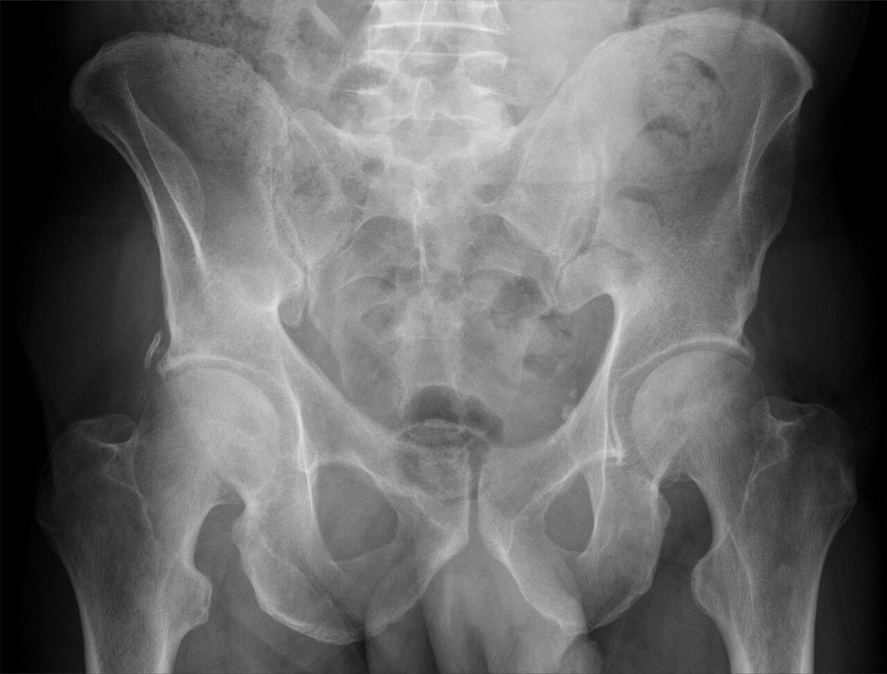 Avulsion fracture