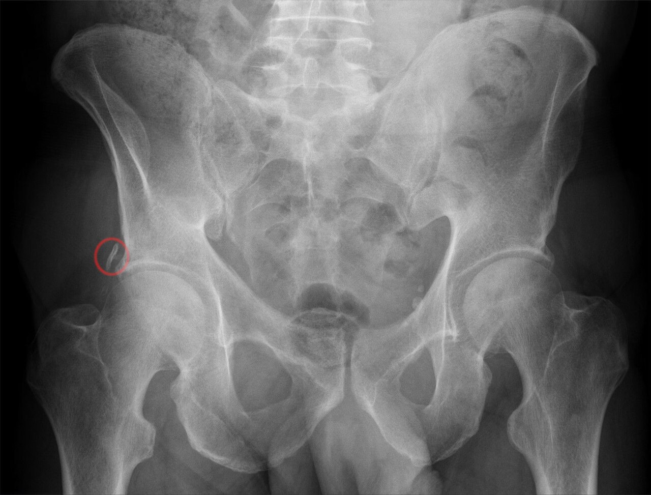 Avulsion fracture