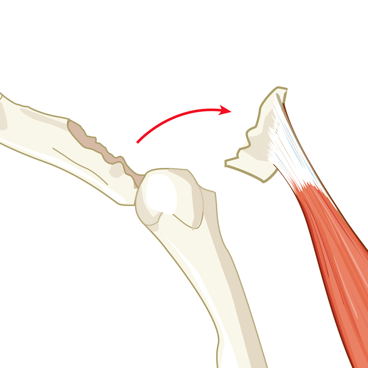 Avulsion fracture