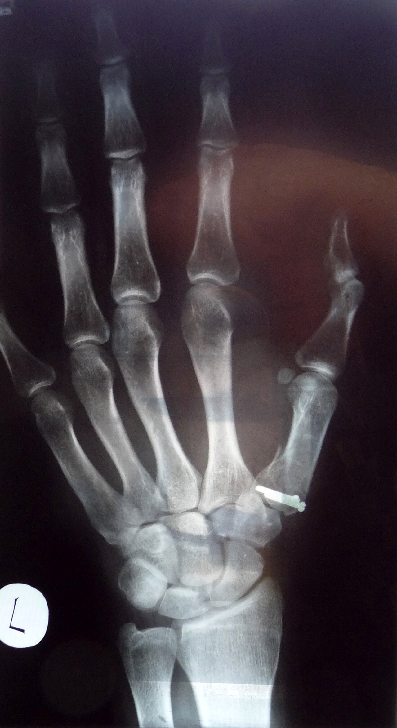 Bennett's fracture