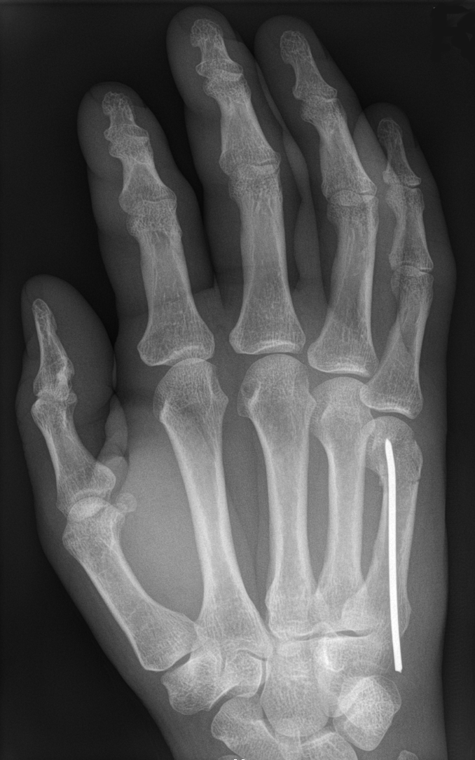 Boxer's fracture