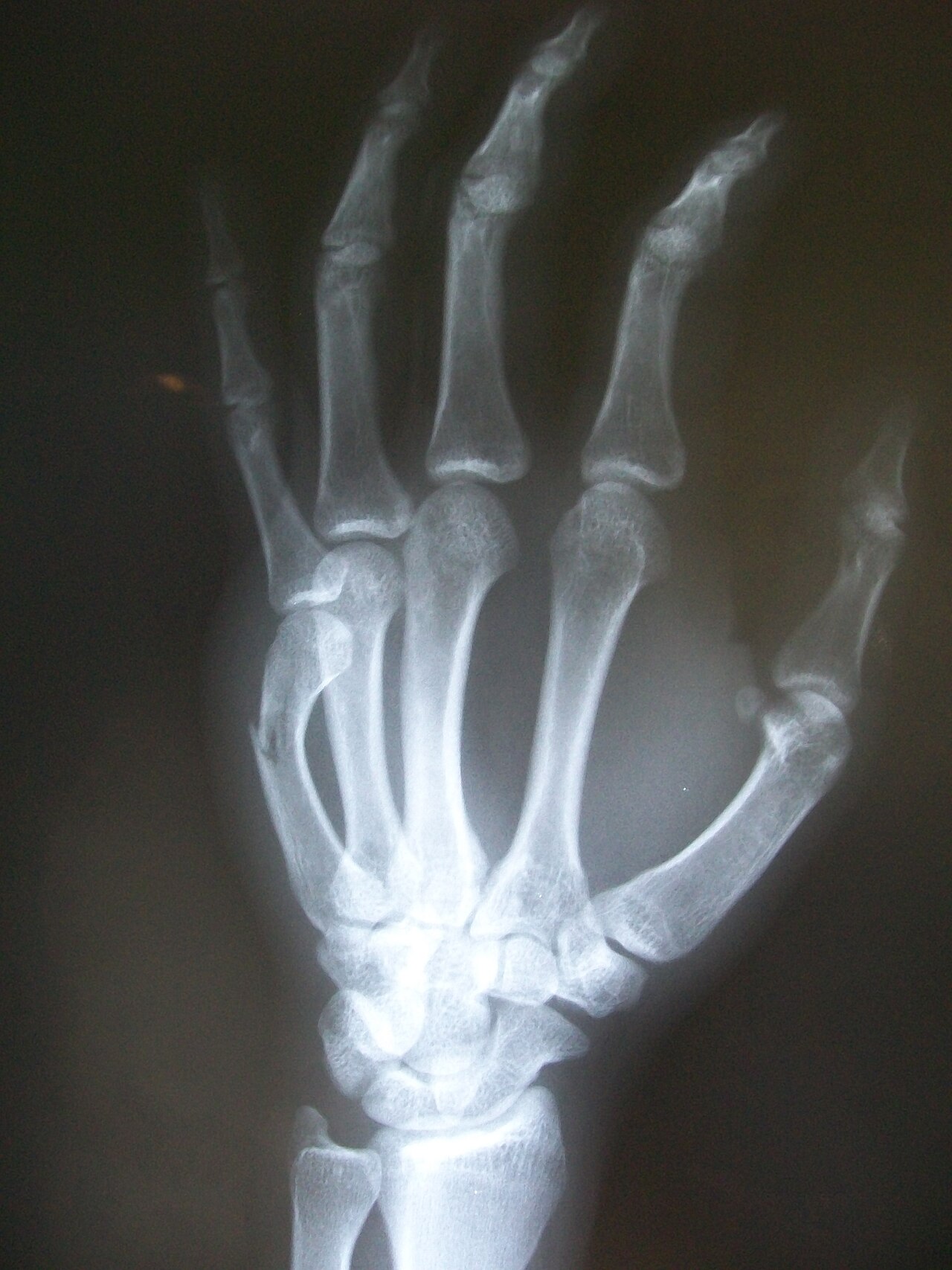 Boxer's fracture