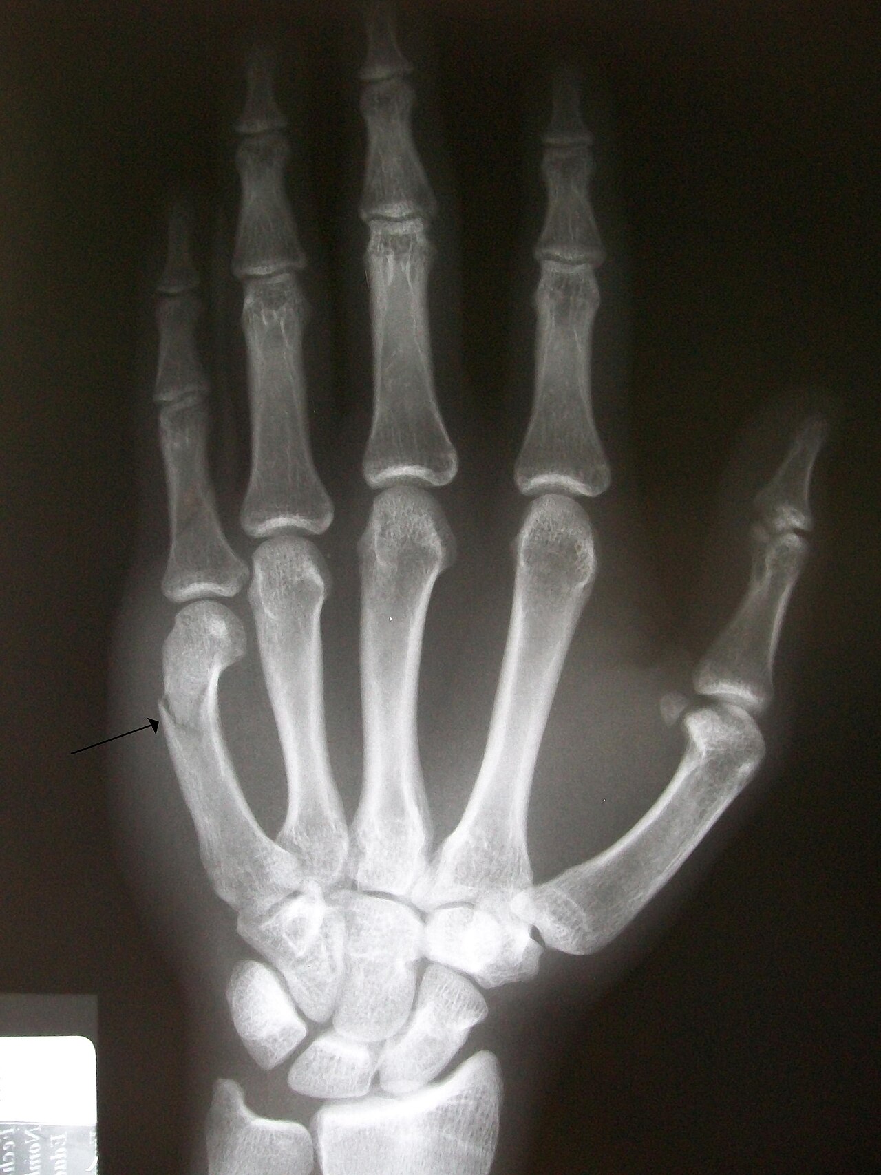 Boxer's fracture