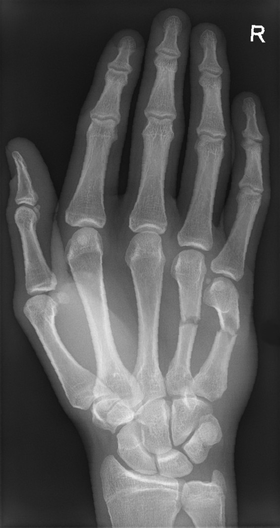 Boxer's fracture
