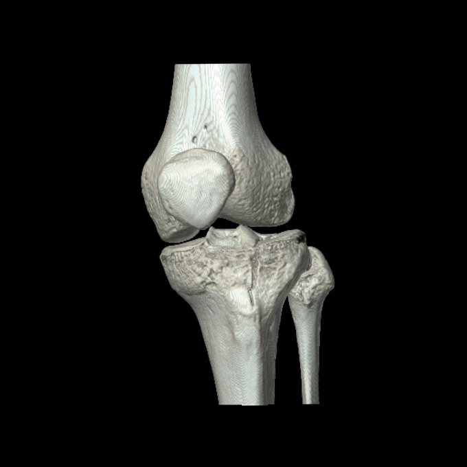 Bumper fracture