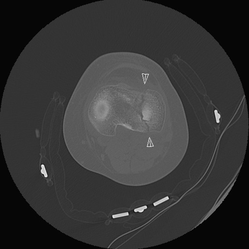 Bumper fracture