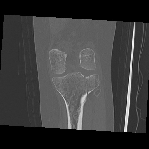 Bumper fracture