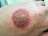 Aerosol burn