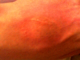 Aerosol burn