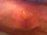 Aerosol burn