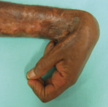 Burn scar contracture