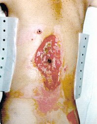 Electrical burn