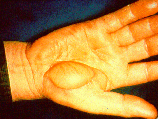 Electrical burn