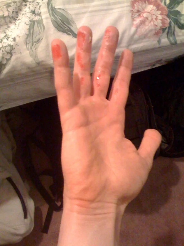 Friction burn