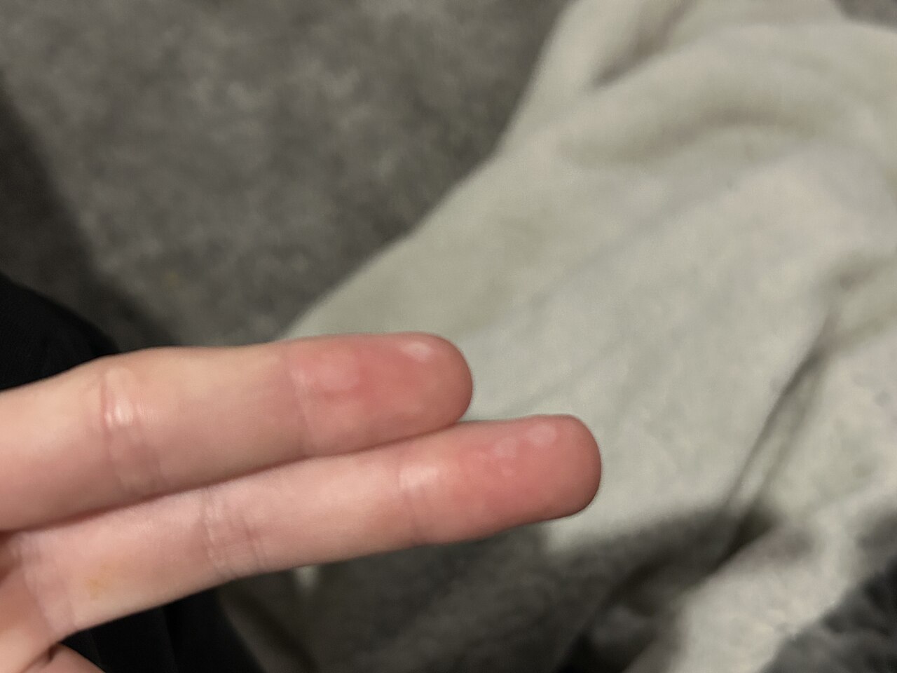 Hot tar burn