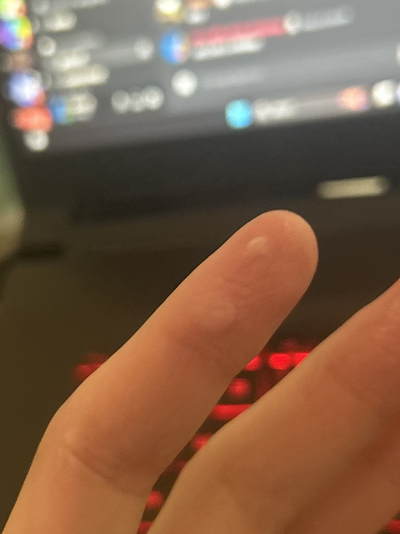 Hot tar burn