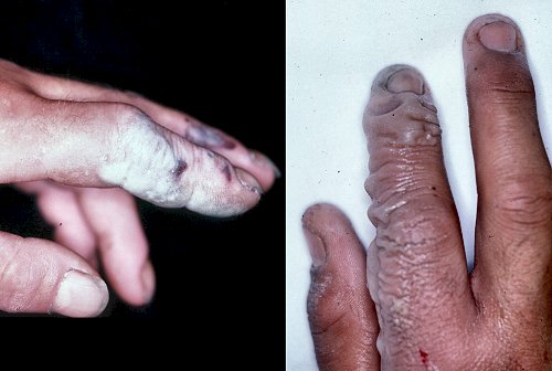 Hydrofluoric acid burn