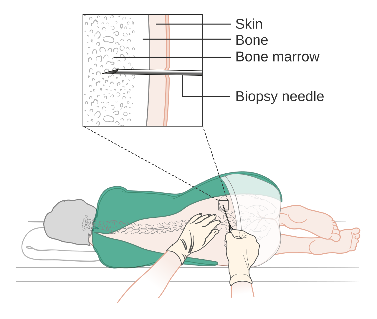 Bone Cancer Research Trust