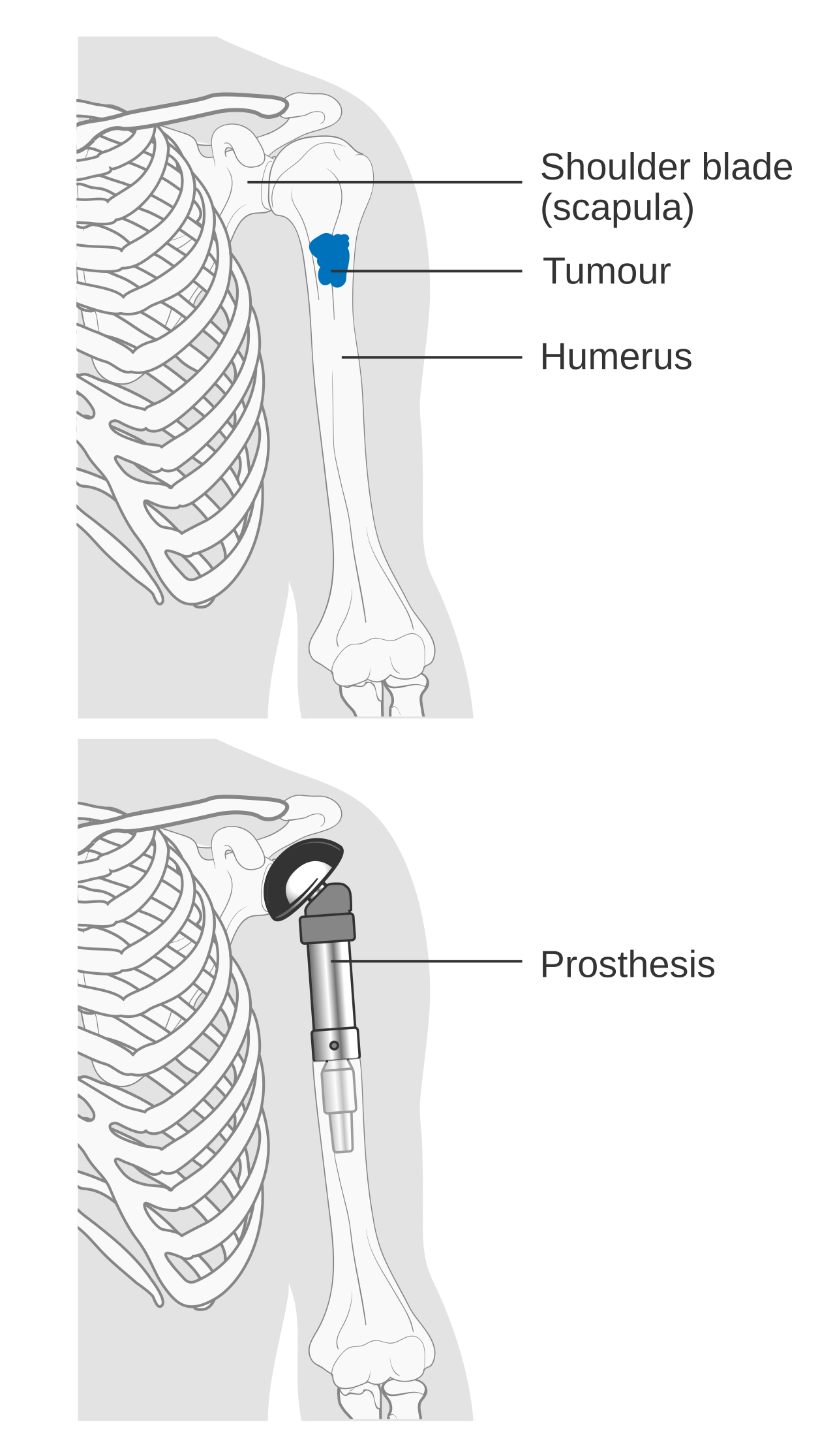 Bone Cancer Research Trust