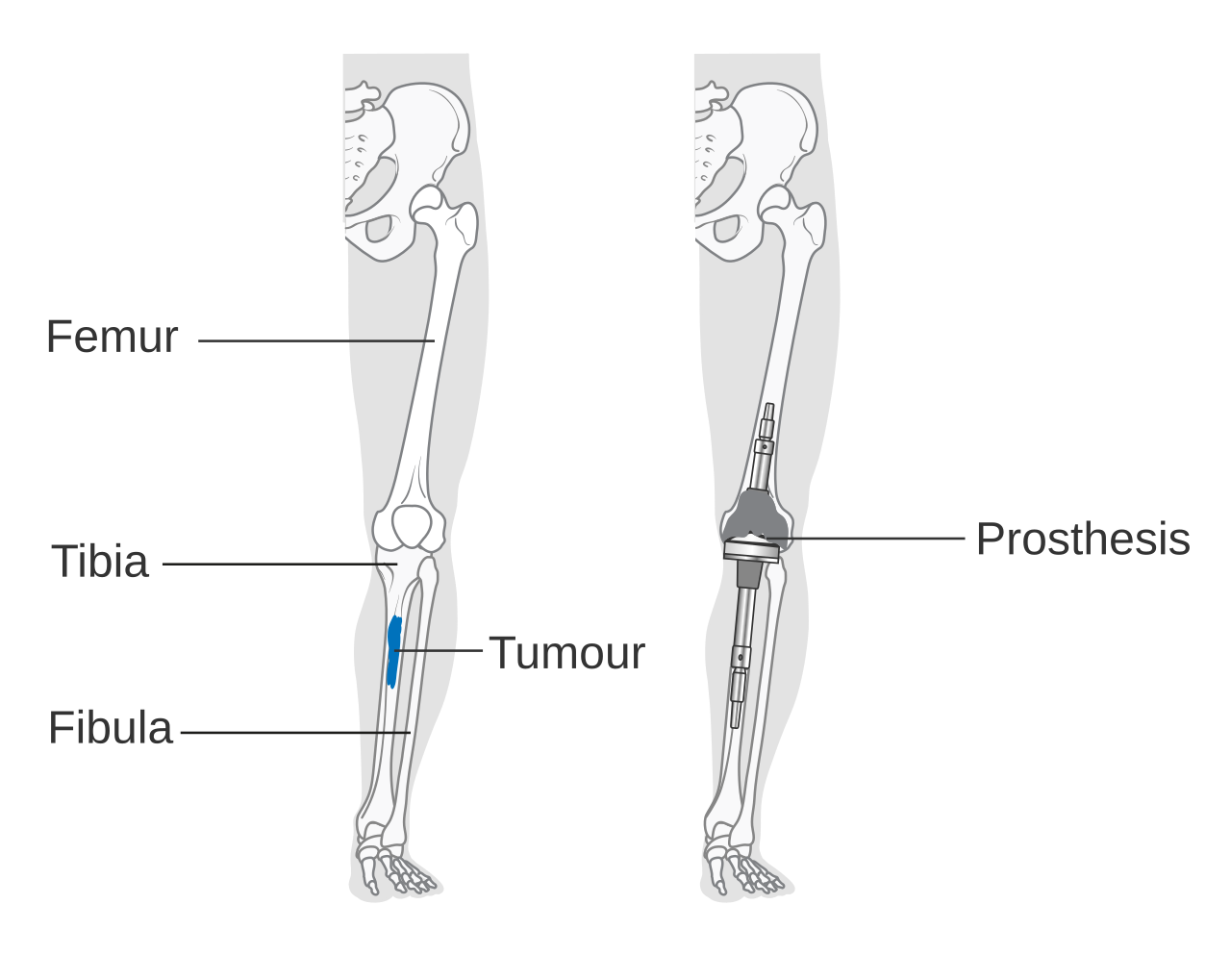 Bone Cancer Research Trust