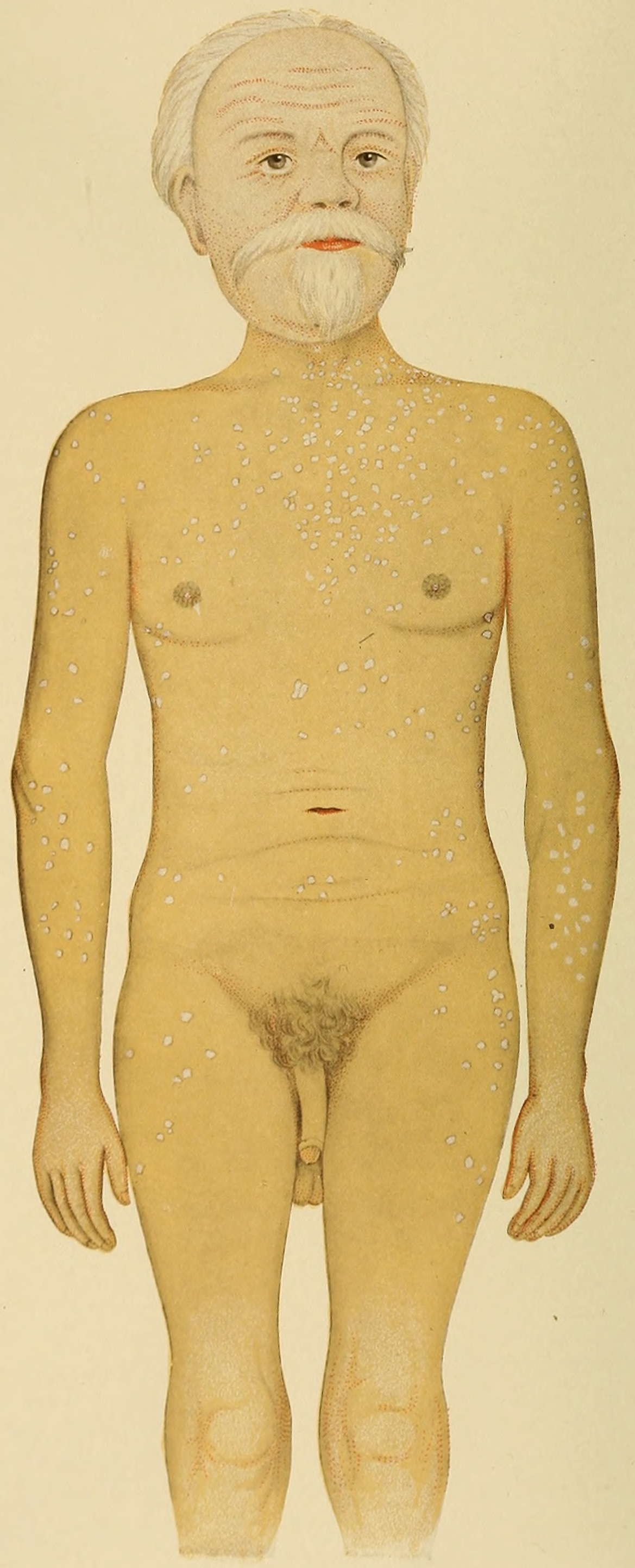 Addison's disease