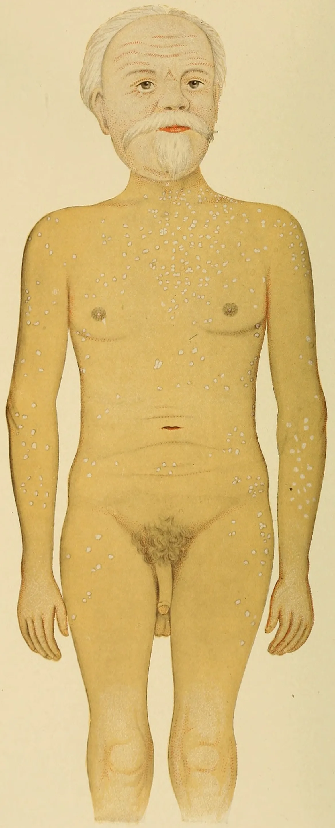 Addison's disease