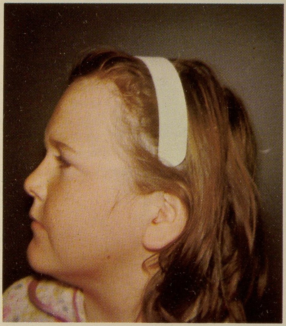 Albright's hereditary osteodystrophy