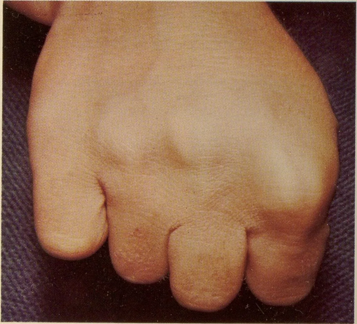 Albright's hereditary osteodystrophy