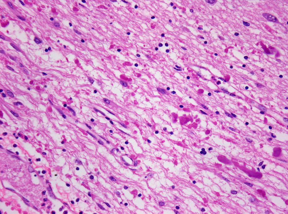 Alexander disease