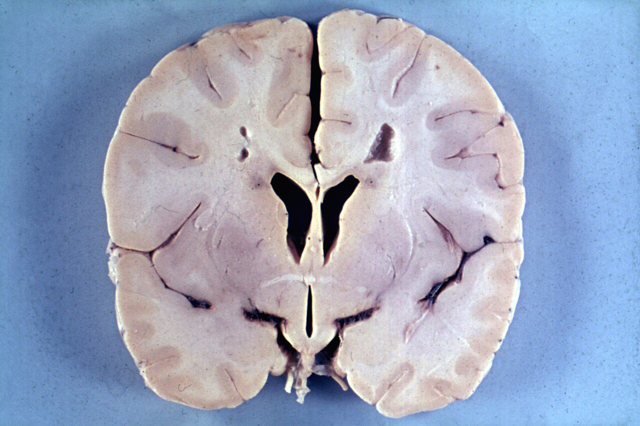 Alexander disease