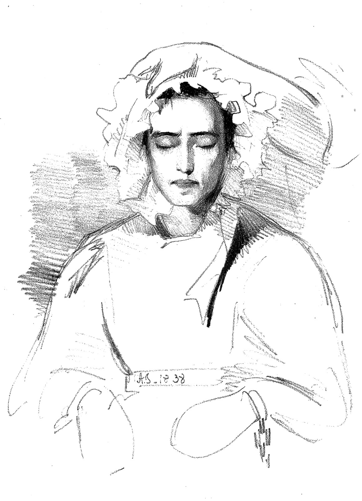 Alexander disease