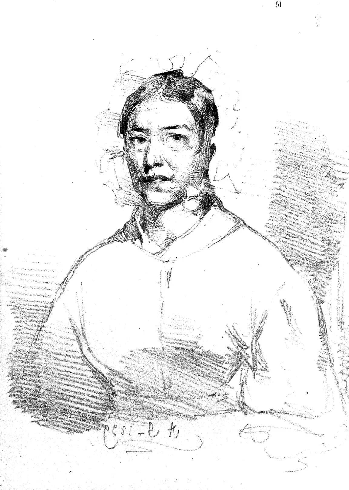 Alexander disease