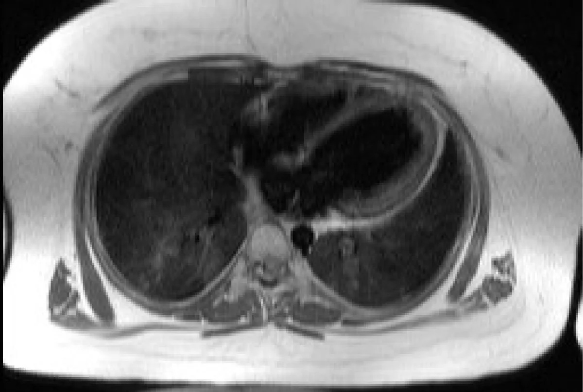 Alström syndrome
