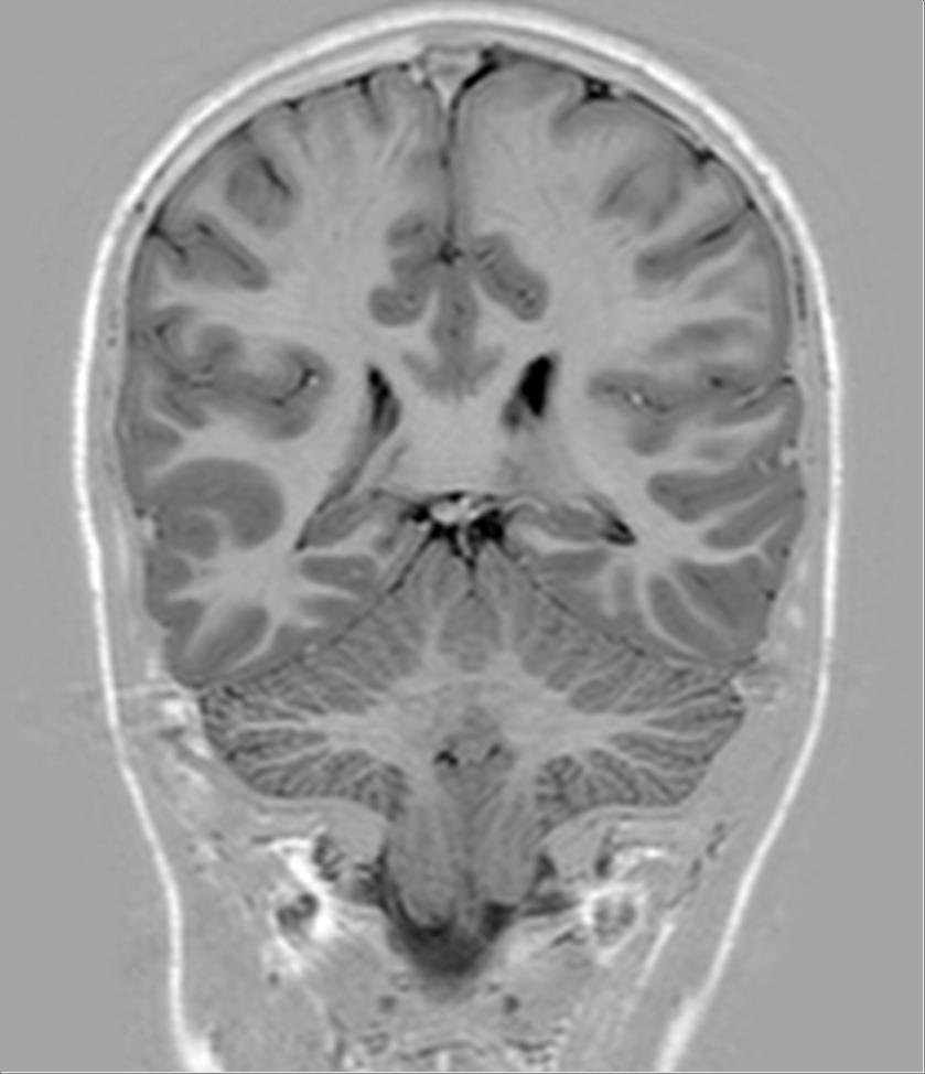 Arnold–Chiari malformation