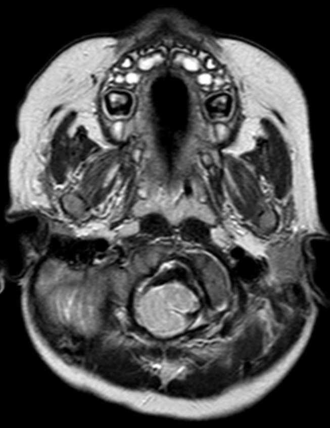 Arnold–Chiari malformation