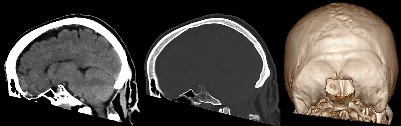 Arnold–Chiari malformation