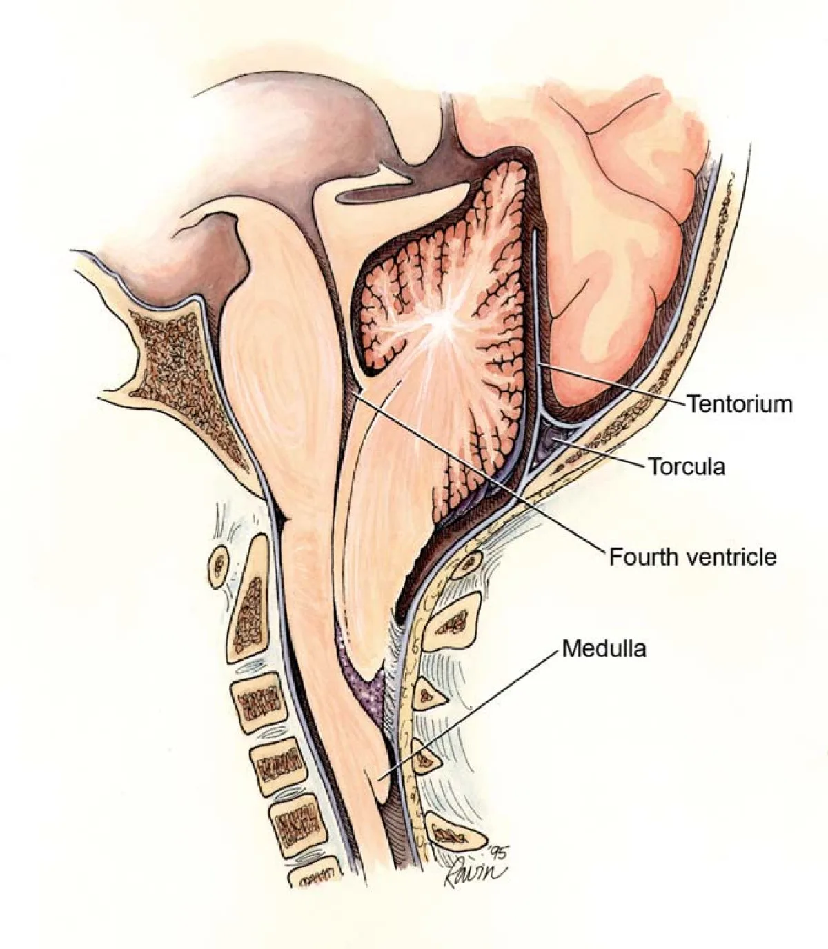 Arnold–Chiari malformation