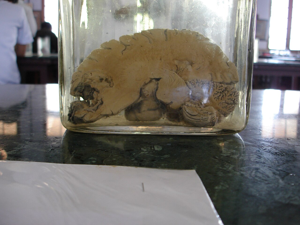Brain abscess