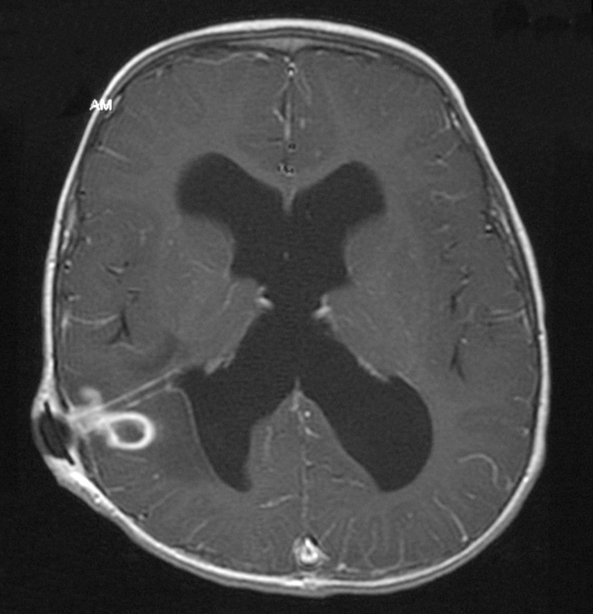 Brain abscess