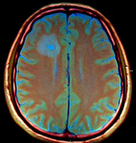 Brain abscess