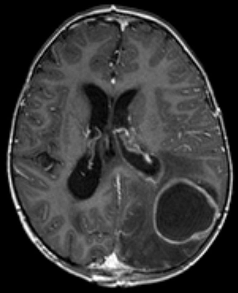 Brain abscess
